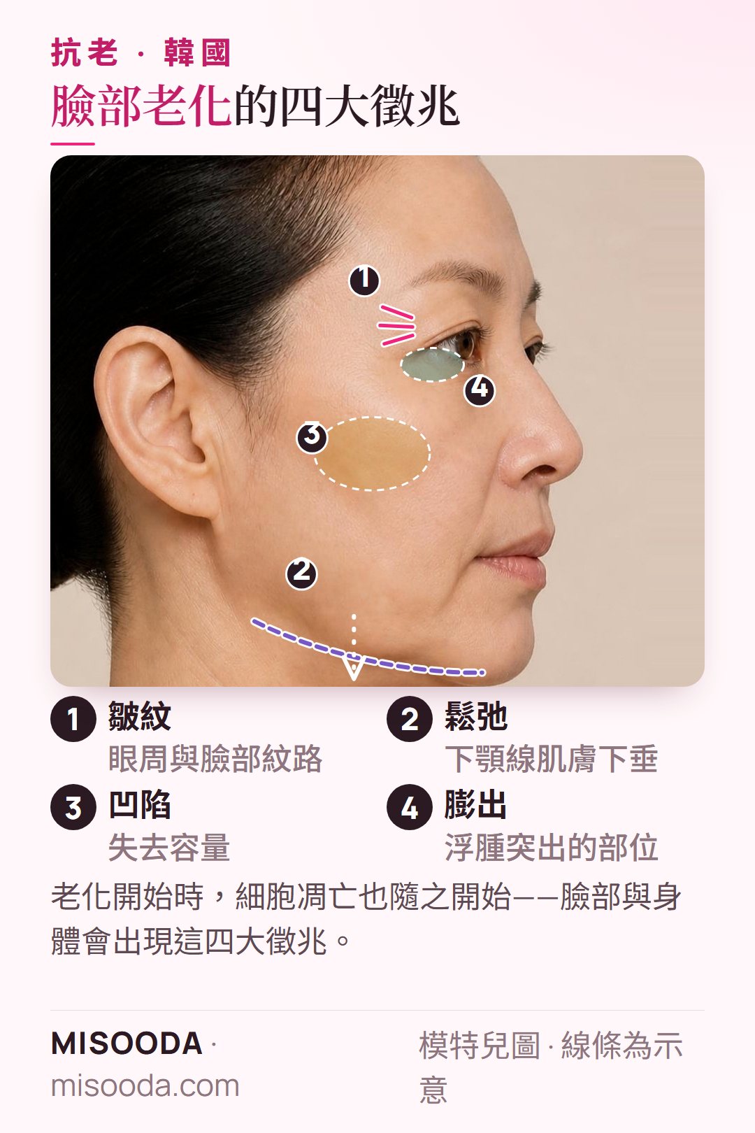 韓國 抗老手術:側臉示意 4 大老化徵兆——眼周皺紋、下顎線鬆弛、肌膚凹陷與膨出部位