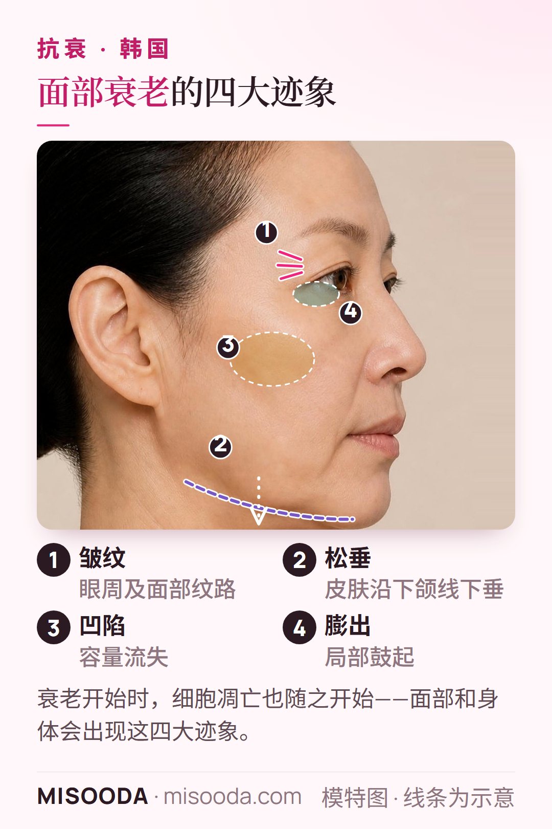 韩国 抗衰手术:侧脸上的 4 大衰老症状——眼周皱纹、下颌线松垂、皮肤凹陷与局部膨出