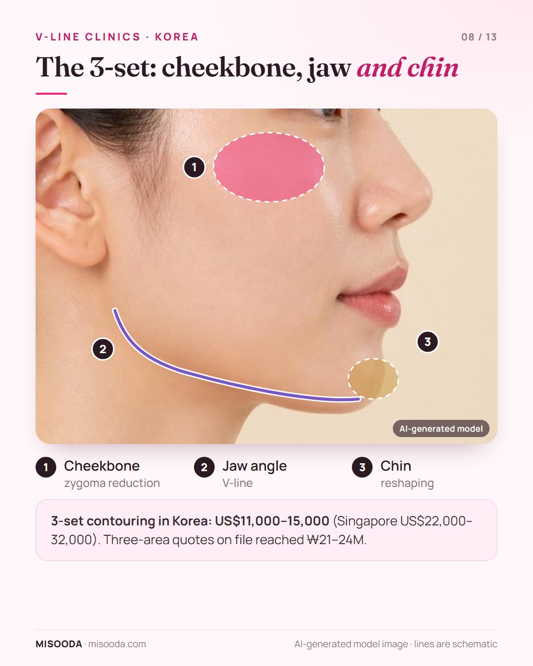 3-set facial contouring on a side profile: cheekbone, jaw angle and chin together for US$11,000–15,000 in Korea vs US$22,000–32,000 in Singapore