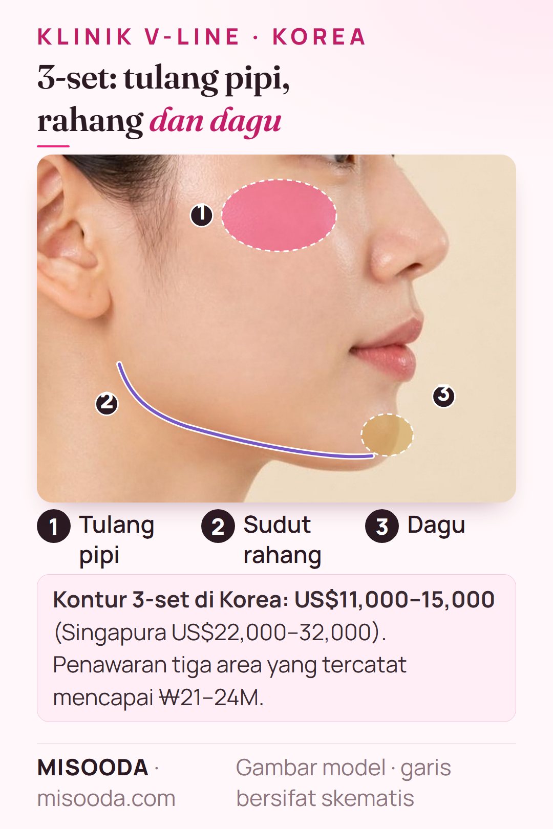 Kontur wajah 3-set di Korea pada profil samping: tulang pipi, sudut rahang, dan dagu sekaligus seharga US$11,000–15,000 vs US$22,000–32,000 di Singapura