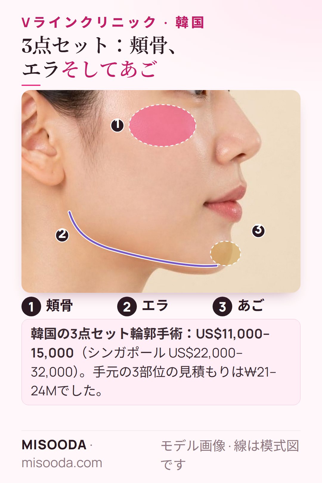 韓国 3点セット顔面輪郭手術を横顔で図示:頬骨、エラ、あごを一緒に、韓国 US$11,000–15,000 対 シンガポール US$22,000–32,000