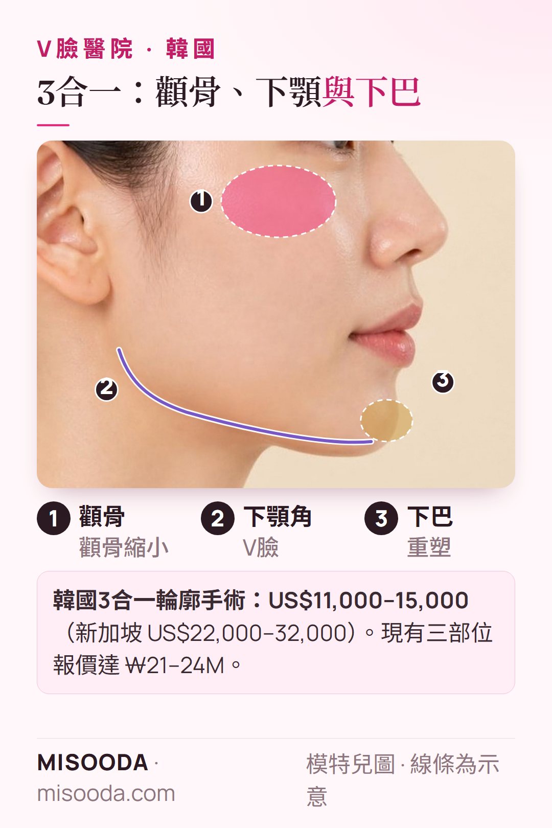 韓國 3合一臉部輪廓側臉示意:顴骨、下顎角與下巴一起做,韓國 US$11,000–15,000 vs 新加坡 US$22,000–32,000