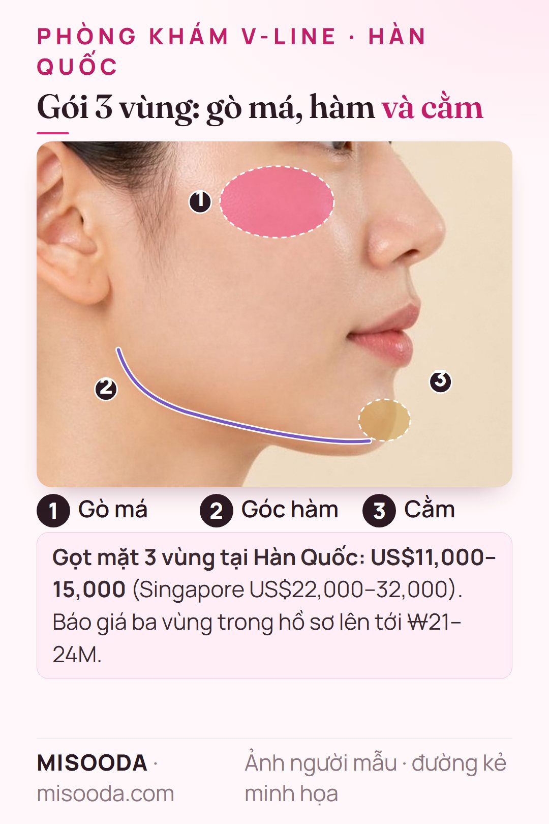 Gọt mặt 3 vùng trên góc nghiêng: gò má, góc hàm và cằm cùng lúc với US$11,000–15,000 tại Hàn Quốc so với US$22,000–32,000 tại Singapore