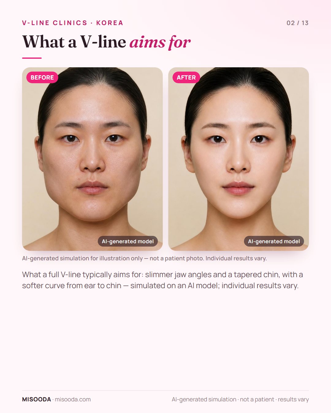 Illustration of the typical goals of full V-line surgery — slimmer jaw angles and a tapered chin with a softer ear-to-chin curve — simulated on an AI model, for comparing Korean clinics