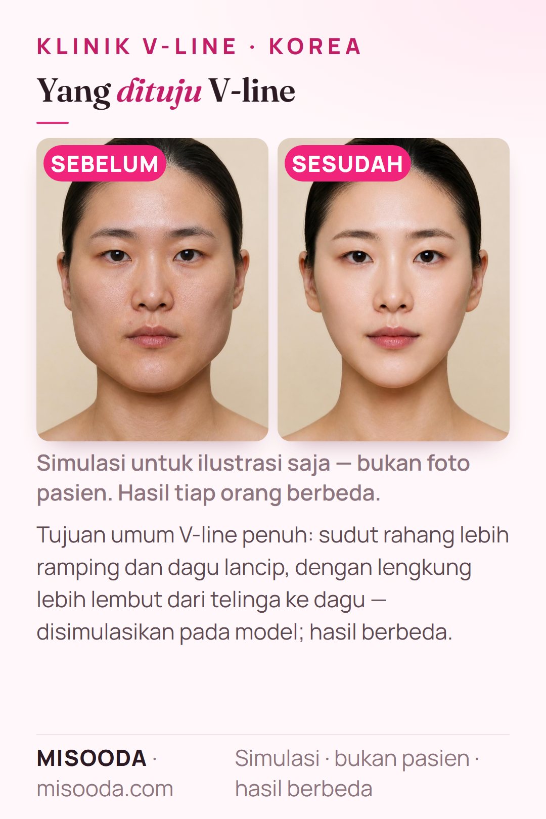 Ilustrasi tujuan umum operasi V-line penuh di Korea — sudut rahang lebih ramping dan dagu lancip dengan lengkung telinga ke dagu lebih lembut — disimulasikan pada model