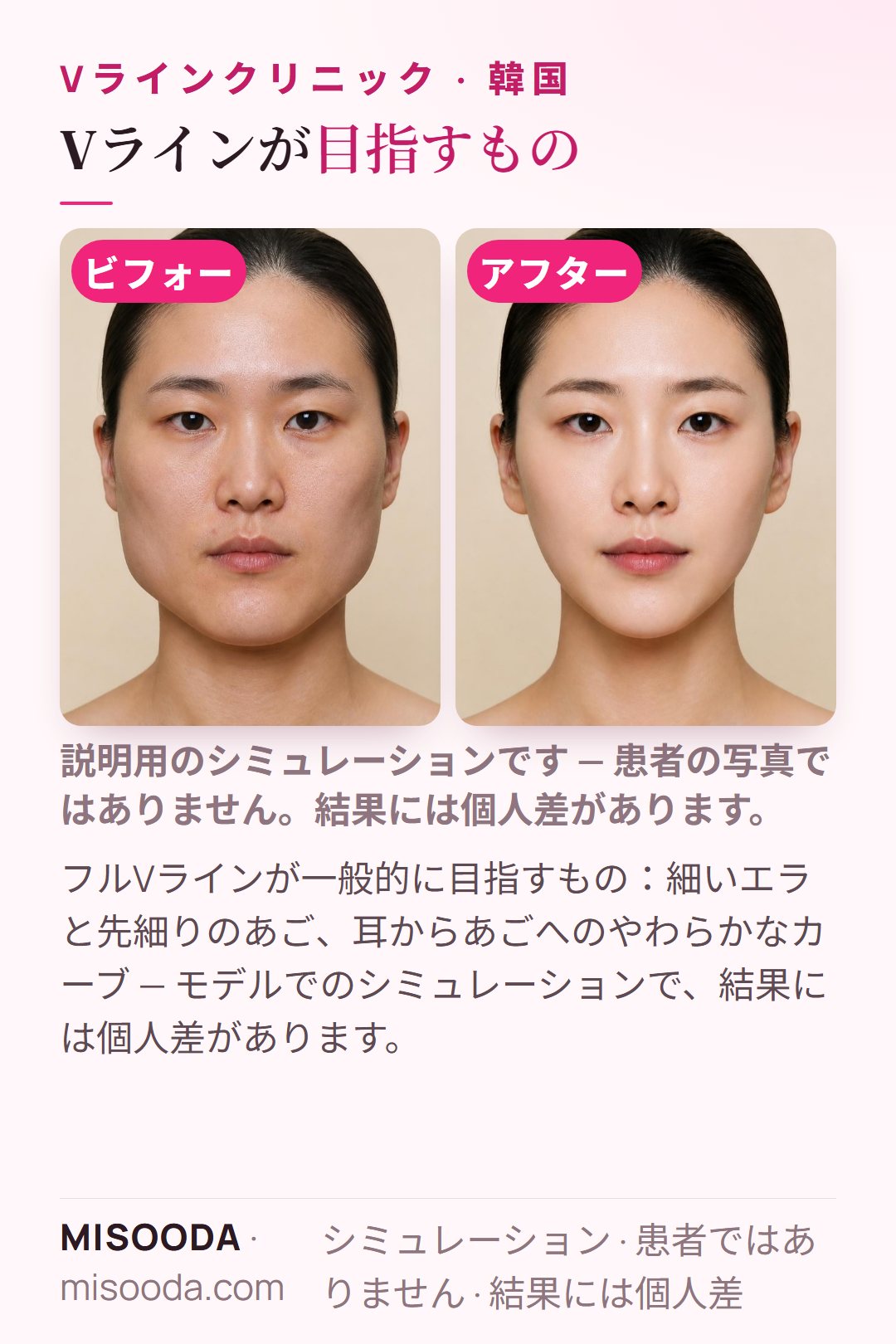 韓国 Vライン手術が一般的に目指すもの — 細いエラと先細りのあご、耳からあごへのやわらかなカーブ — をモデルでシミュレーションしたイラスト