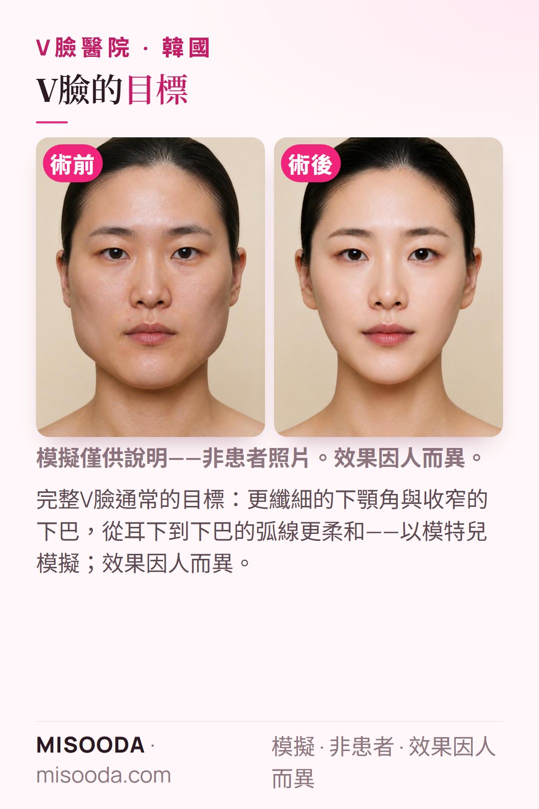 韓國 V臉手術典型目標示意——更纖細的下顎角、收窄的下巴與更柔和的耳下至下巴弧線——以模特兒模擬,供比較韓國醫院