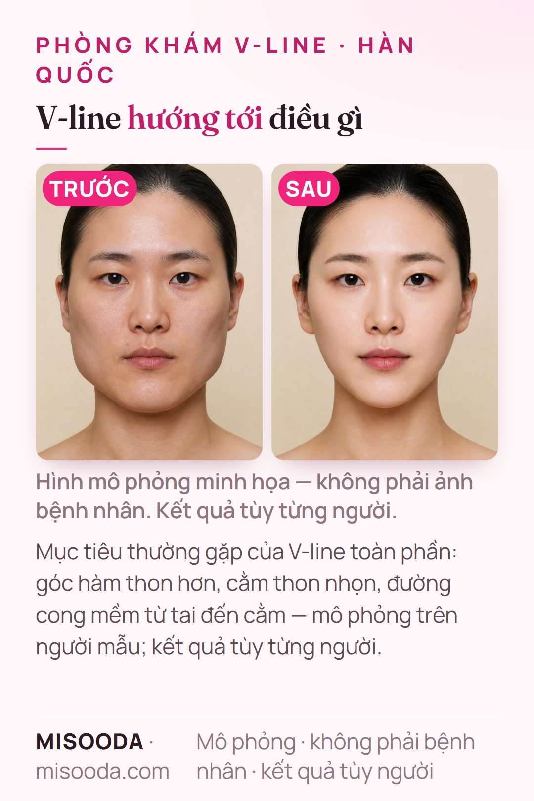 Minh họa mục tiêu thường gặp của phẫu thuật V-line toàn phần — góc hàm thon hơn, cằm thon nhọn, đường cong mềm từ tai đến cằm — mô phỏng trên người mẫu, để so sánh phòng khám Hàn Quốc