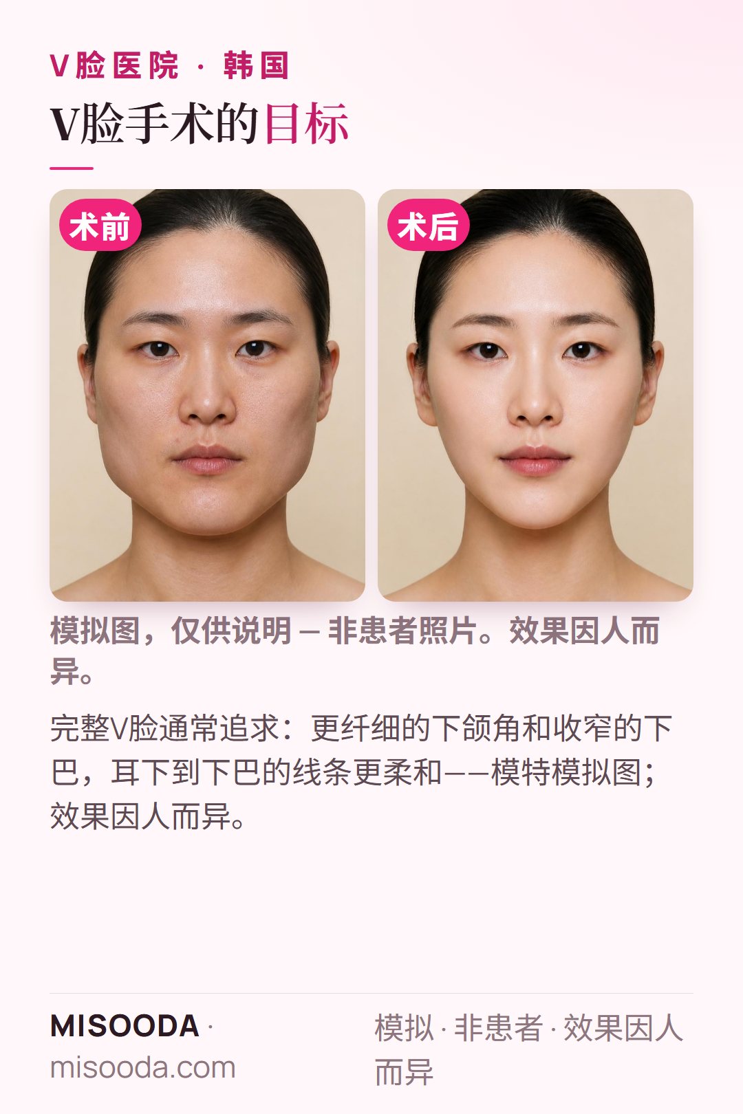 韩国 V脸手术典型目标示意:更纤细的下颌角、收窄的下巴、耳下到下巴线条更柔和——模特模拟图,用于比较韩国医院