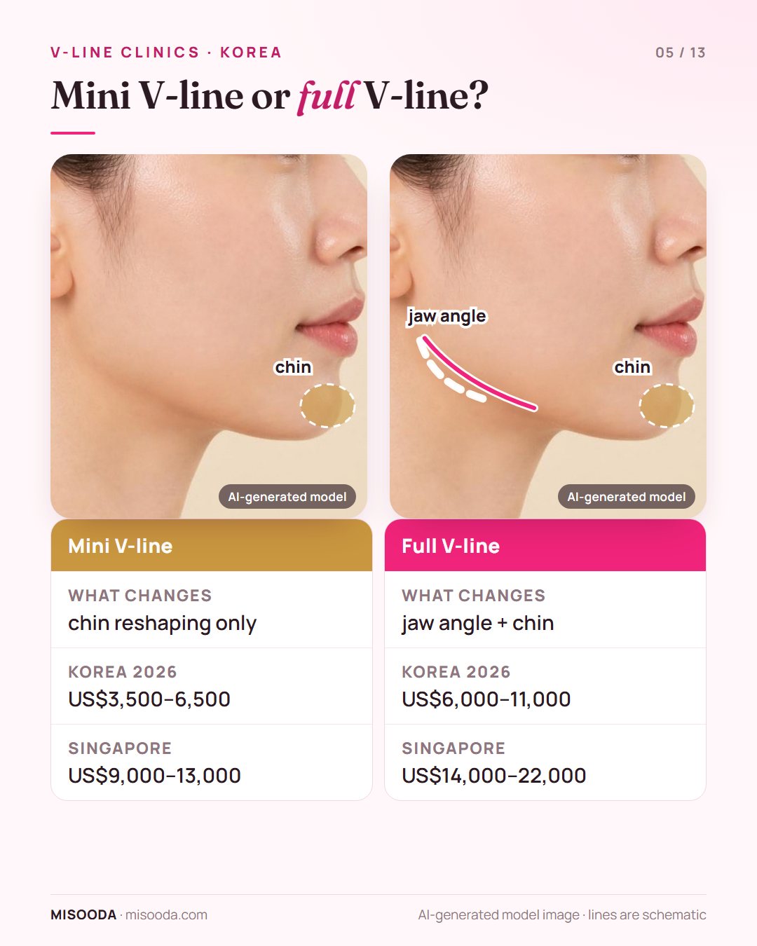 Mini V-line (chin reshaping, US$3,500–6,500) vs full V-line (jaw angle + chin, US$6,000–11,000) in Korea shown on a side profile, vs Singapore prices