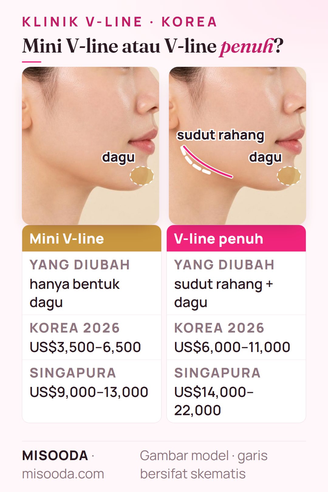 Mini V-line (bentuk dagu, US$3,500–6,500) vs V-line penuh (sudut rahang + dagu, US$6,000–11,000) di Korea pada profil samping, dibandingkan harga Singapura