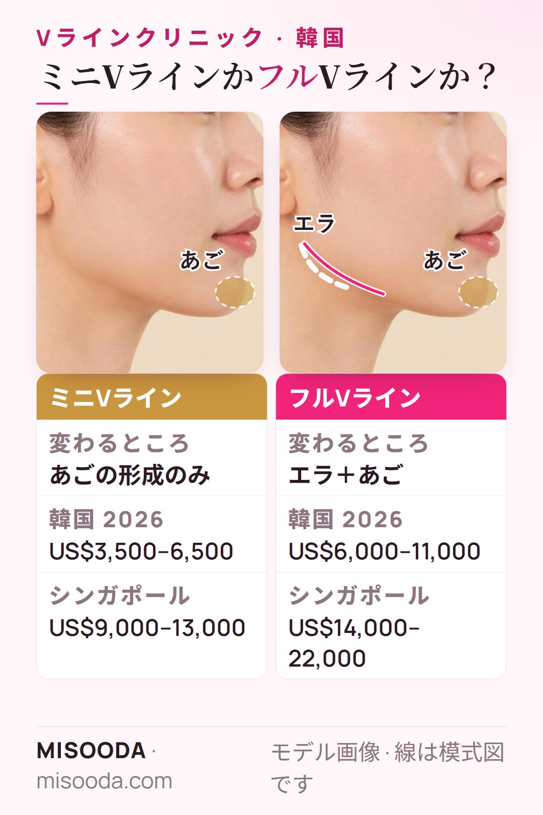 韓国 ミニVライン(あごの形成、US$3,500–6,500)とフルVライン(エラ+あご、US$6,000–11,000)を横顔で比較、シンガポール価格も