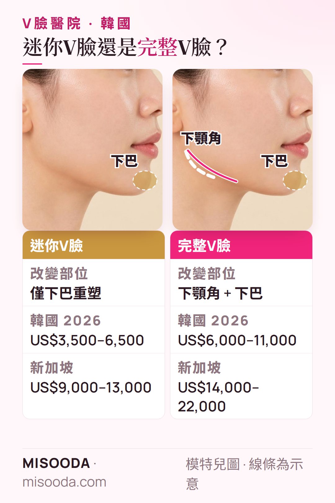 韓國迷你V臉(下巴重塑,US$3,500–6,500)vs 完整 V臉(下顎角 + 下巴,US$6,000–11,000)側臉示意,並與新加坡價格比較