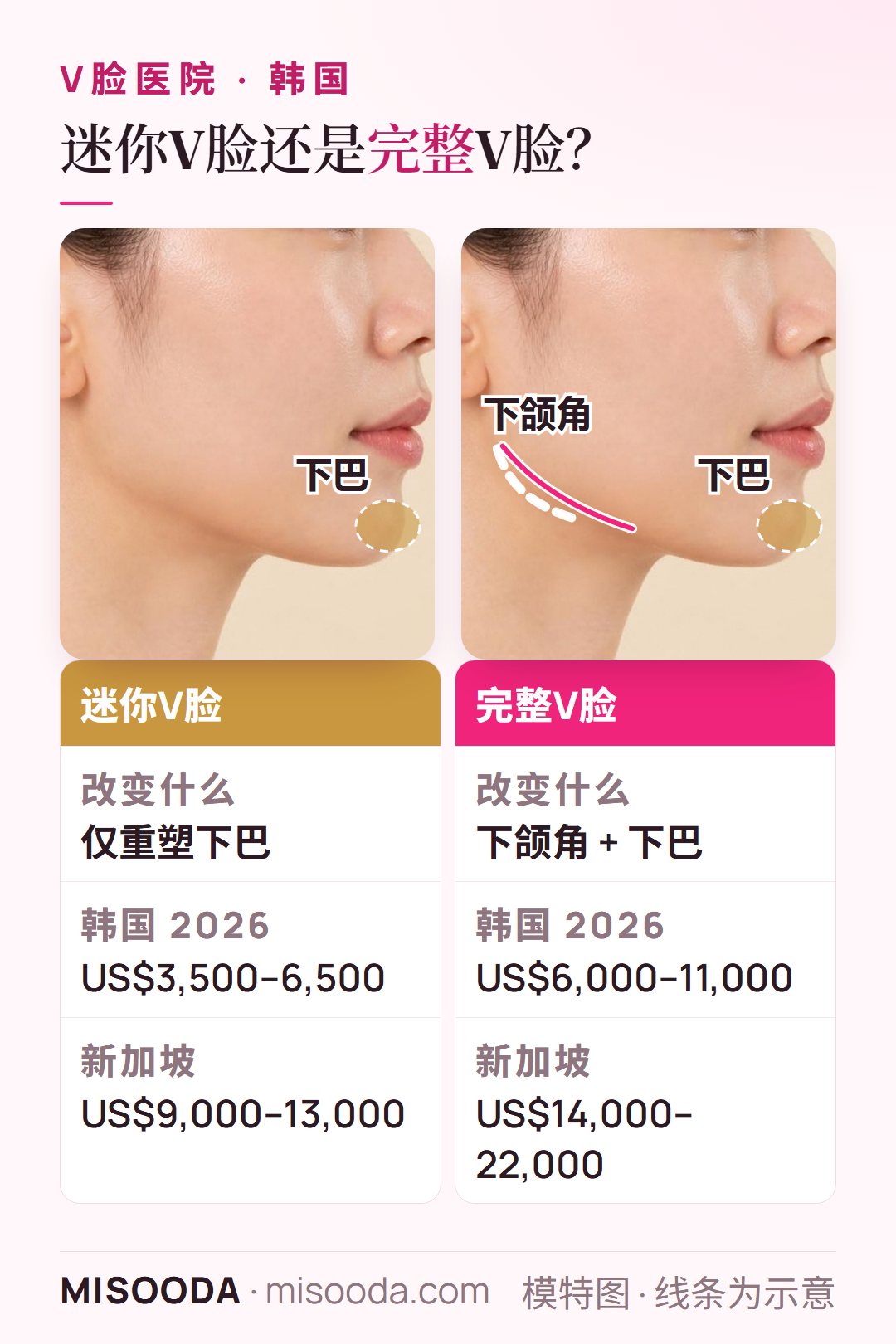 韩国迷你V脸(下巴重塑,US$3,500–6,500)与完整V脸(下颌角 + 下巴,US$6,000–11,000)侧面对比,并附新加坡价格