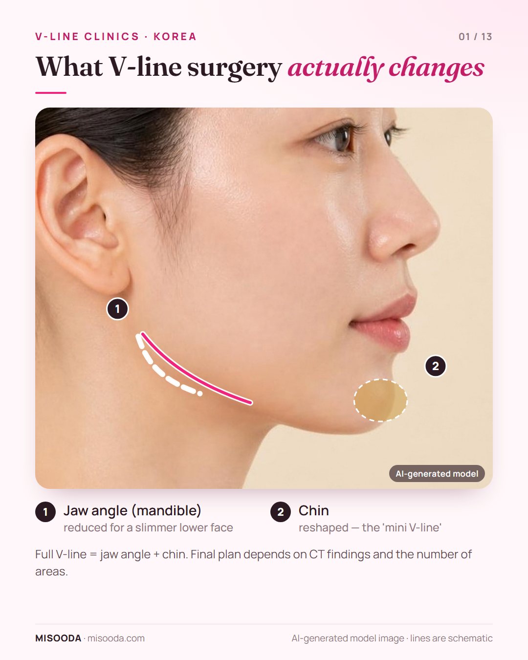 V-line surgery zones on a side profile: jaw angle reduction and chin reshaping for a slimmer lower face, as compared across Korean contouring clinics