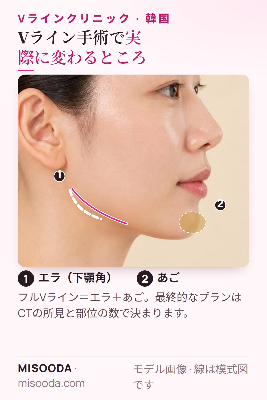 韓国 Vライン手術の部位を横顔で図示:顔の下半分をすっきりさせるエラの縮小とあごの形成。韓国の輪郭手術クリニックを比較
