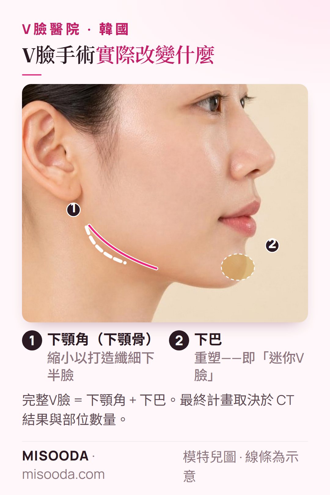 韓國 V臉手術部位側臉示意:縮小下顎角與重塑下巴,打造纖細下半臉,比較韓國各輪廓手術醫院