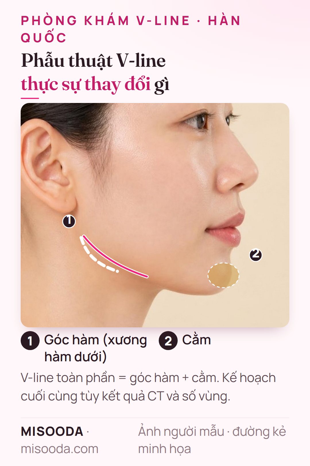 Các vùng phẫu thuật V-line Hàn Quốc trên góc nghiêng: gọt góc hàm và tạo hình cằm cho nửa dưới mặt thon hơn, như so sánh giữa các phòng khám gọt mặt