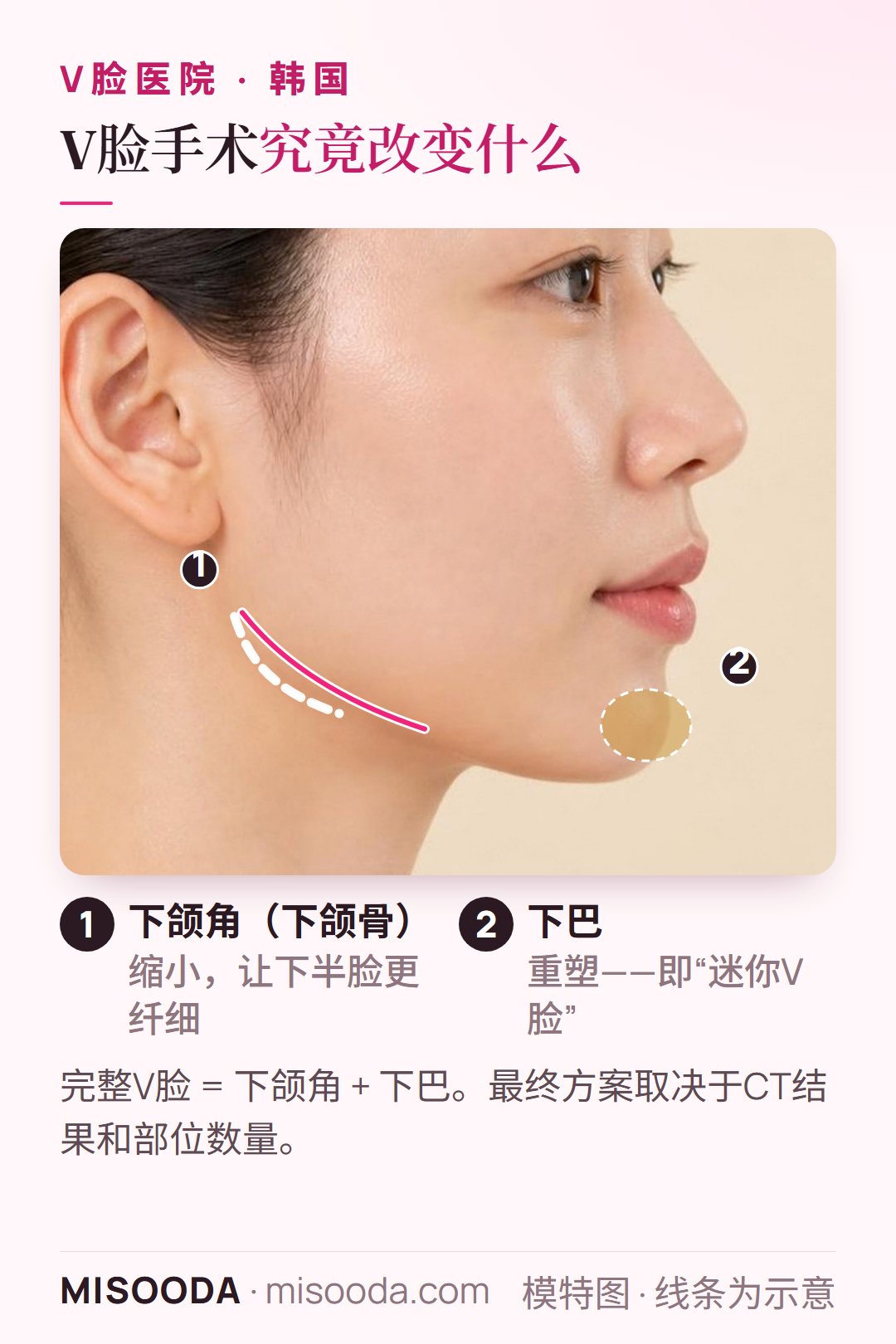 韩国 V脸手术部位侧面图:下颌角缩小与下巴重塑,让下半脸更纤细,用于比较韩国面部轮廓医院