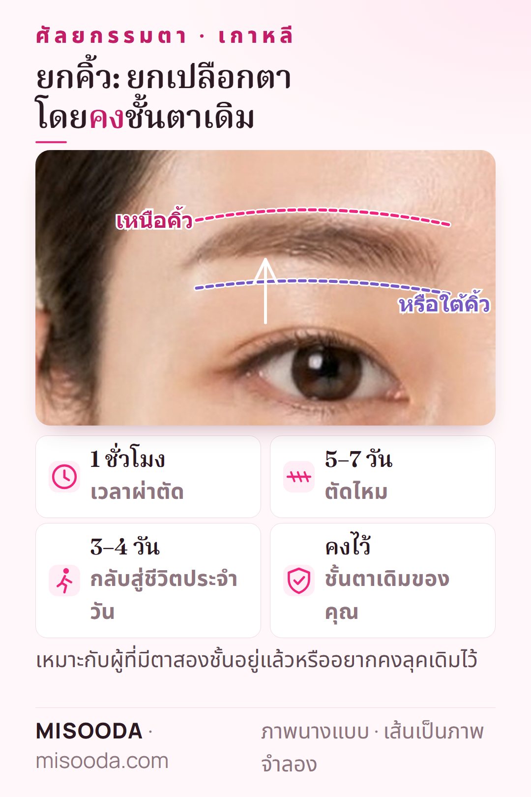 ยกคิ้วแก้เปลือกตาหย่อนในเกาหลี: แผลเหนือหรือใต้คิ้วช่วยยกผิวโดยคงตาสองชั้นเดิม ใช้เวลา 1 ชั่วโมง ตัดไหมใน 5–7 วัน