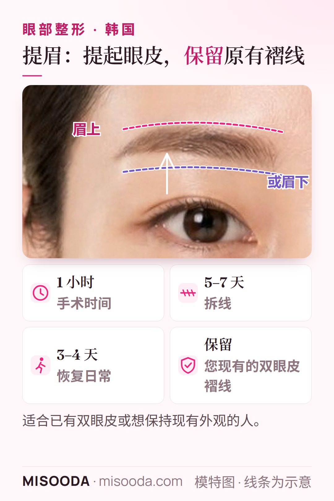 韩国 提眉改善眼皮下垂:在眉上或眉下切口提起皮肤,同时保留原有双眼皮;手术 1 小时,5–7 天拆线