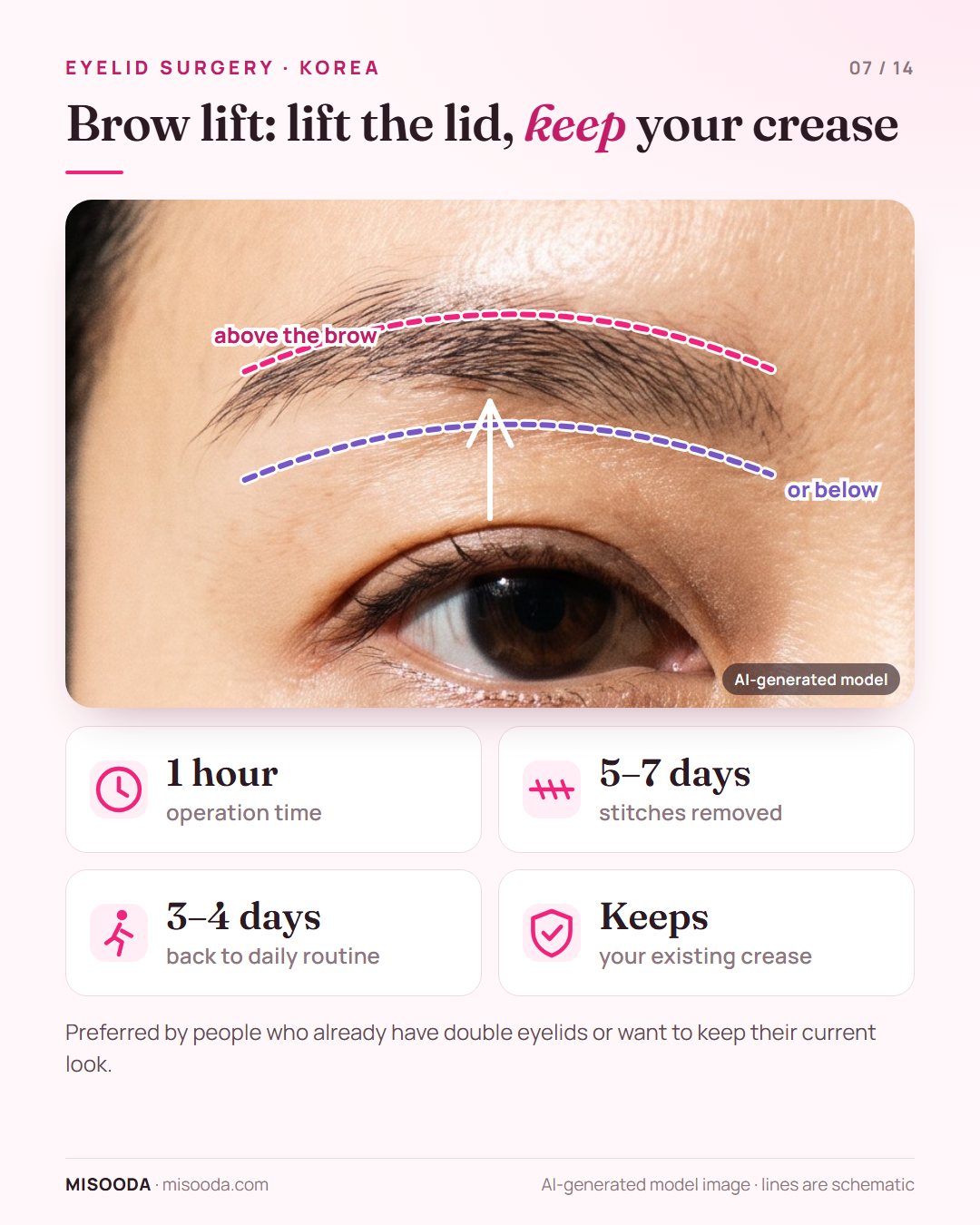 Brow lift for droopy eyelids in Korea: incision above or below the eyebrow lifts skin while keeping the existing double eyelid; 1 hour, stitches out in 5–7 days