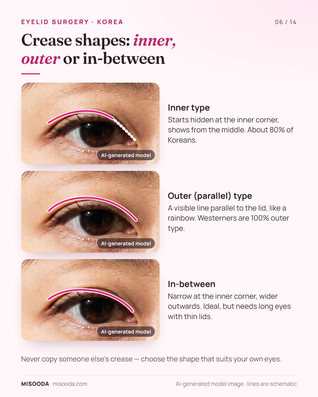 Double eyelid crease shapes: inner type (about 80% of Koreans), outer parallel type (Westerners are 100% outer) and the in-between inner-outer line