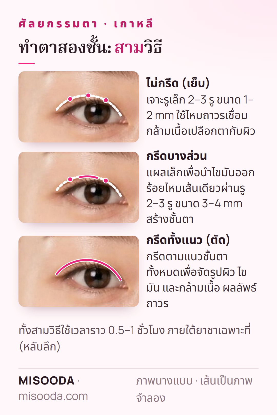 วิธีทำตาสองชั้นบนเปลือกตา: ไม่กรีดเจาะรูเล็ก 2–3 รู ขนาด 1–2 mm กรีดบางส่วนรู 3–4 mm และกรีดทั้งแนวตามชั้นตา