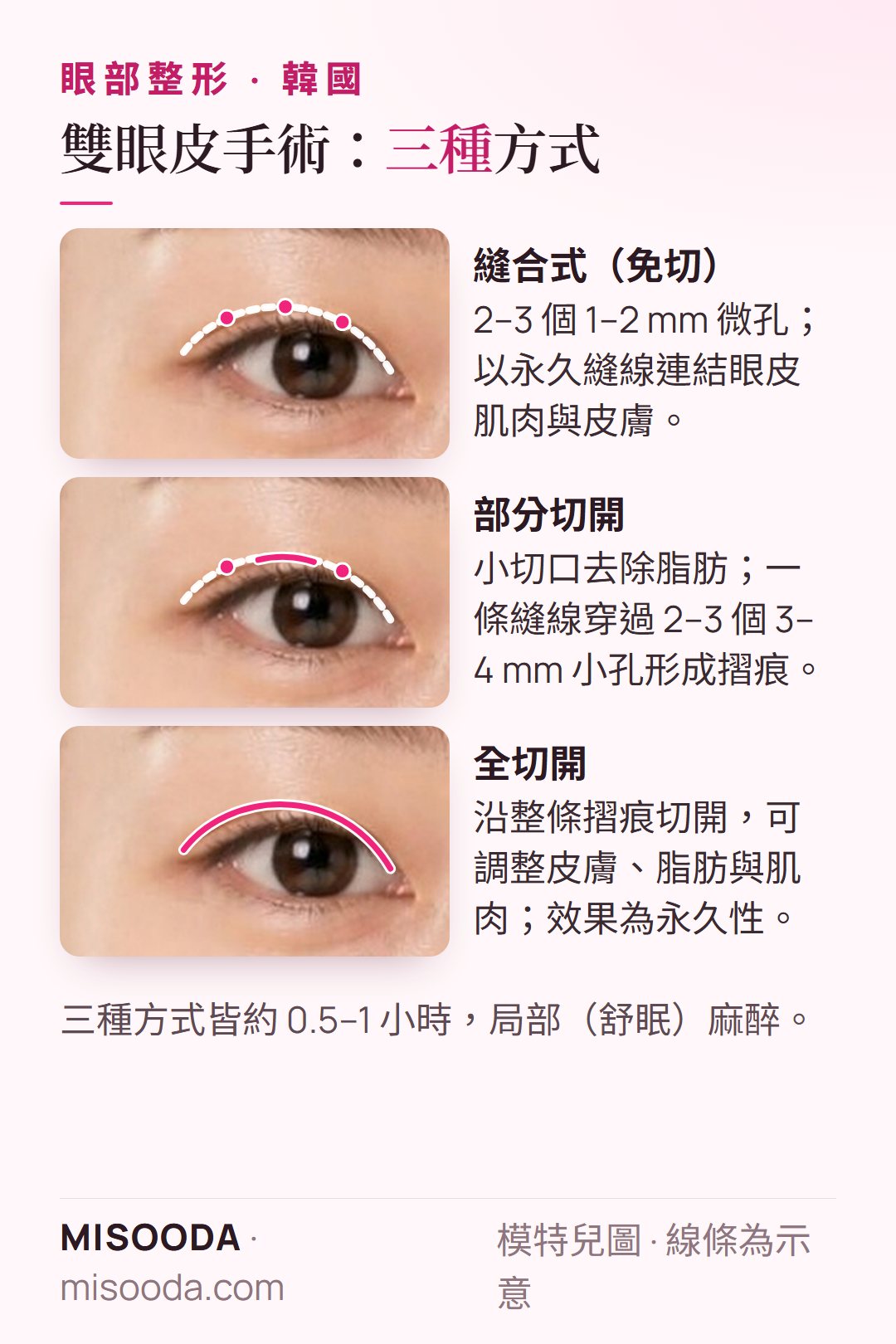 韓國 雙眼皮手術方式:縫合式 2–3 個 1–2 mm 微孔、部分切開 3–4 mm 小孔,以及沿摺痕全切開
