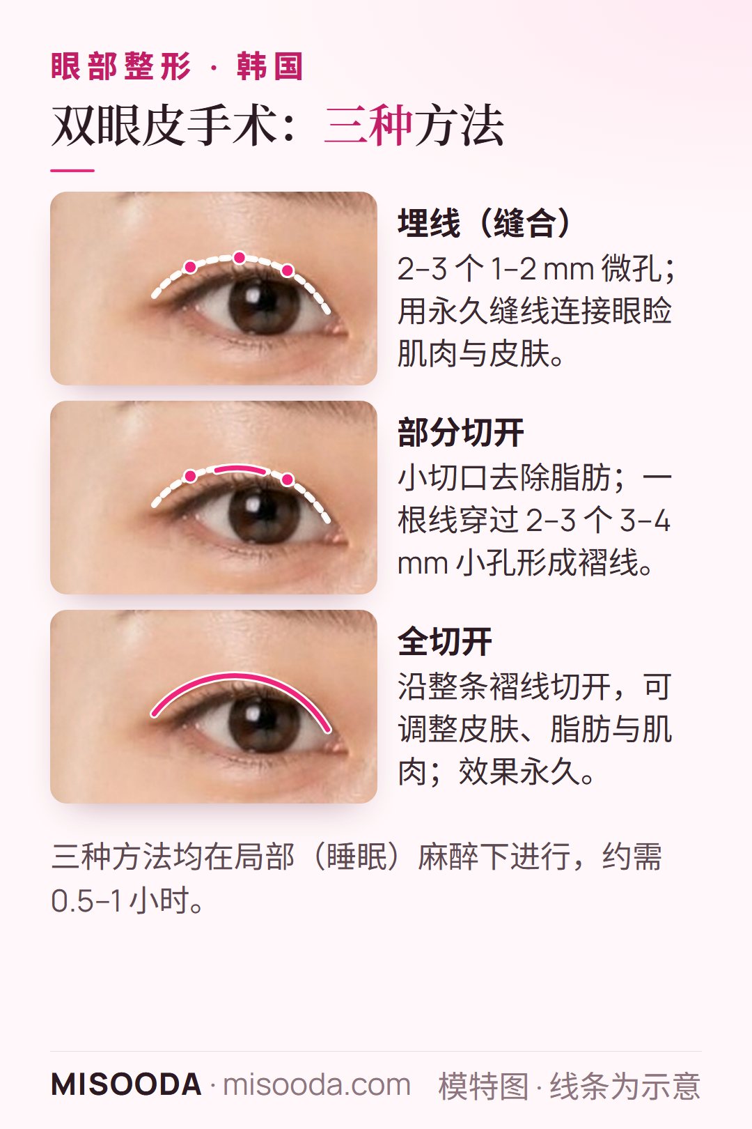 韩国 双眼皮手术方法:埋线法用 2–3 个 1–2 mm 微孔,部分切开用 3–4 mm 小孔,全切开沿整条褶线切开