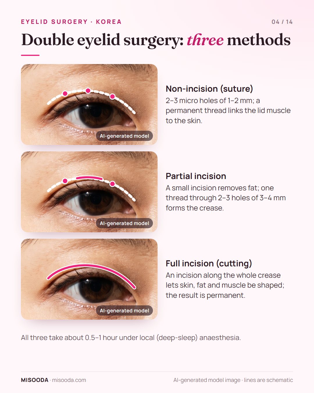 Double eyelid surgery methods on the eyelid: non-incision with 2–3 micro holes of 1–2 mm, partial incision with 3–4 mm holes, and full incision along the crease