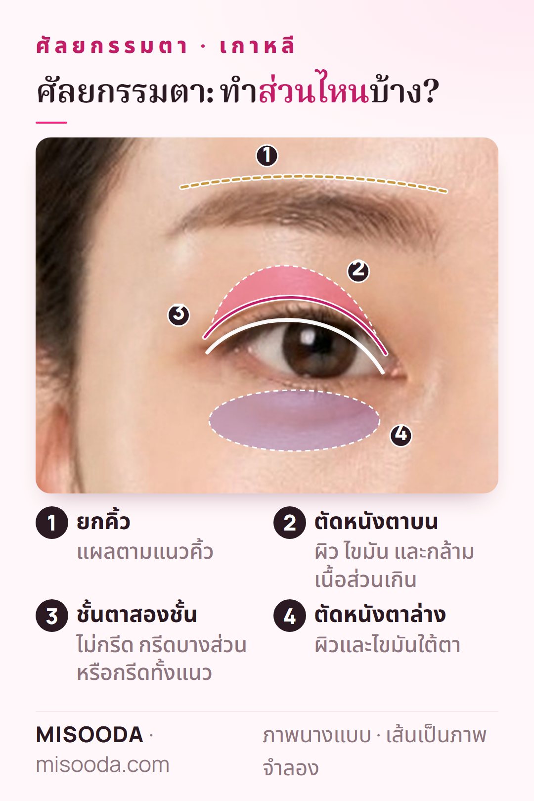 แผนที่ศัลยกรรมตา เกาหลี บนภาพดวงตาด้านหน้า: แผลยกคิ้ว บริเวณตัดหนังตาบน ชั้นตาสองชั้น และบริเวณใต้ตาสำหรับตัดหนังตาล่าง