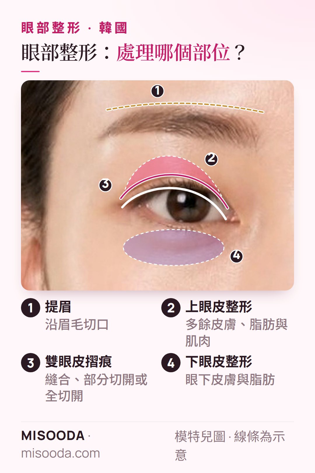 韓國 眼部整形部位圖(眼睛正面):提眉切口、上眼皮整形皮膚區、雙眼皮摺痕與下眼皮整形眼下區域