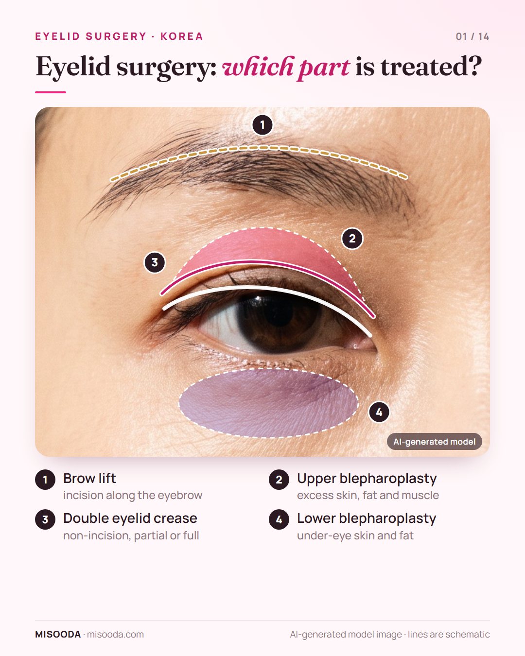 Eyelid surgery map on a front view of the eye: brow lift incision, upper blepharoplasty skin zone, double eyelid crease and lower blepharoplasty under-eye area