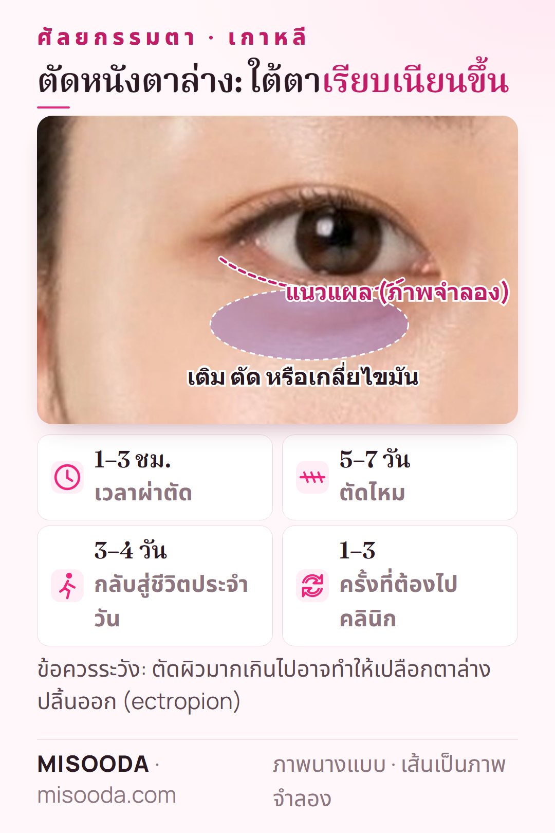 ตัดหนังตาล่างในเกาหลี: ตัดผิวใต้ตาที่หย่อนและเติม ตัด หรือเกลี่ยไขมันใต้ตา ใช้เวลา 1–3 ชั่วโมง ตัดไหมใน 5–7 วัน