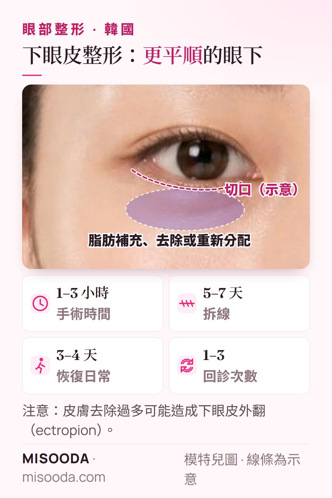韓國 下眼皮整形:去除下垂眼下皮膚,並補充、去除或重新分配眼下脂肪;1–3 小時、5–7 天拆線
