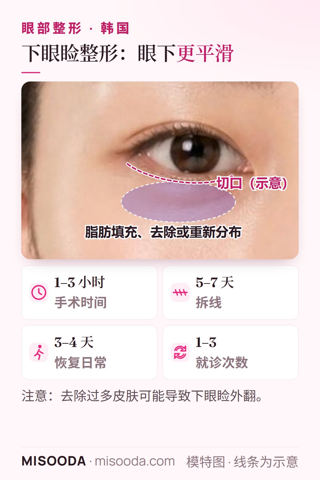 韩国 下眼睑整形:去除松垂的眼下皮肤,眼下脂肪可填充、去除或重新分布;手术 1–3 小时,5–7 天拆线