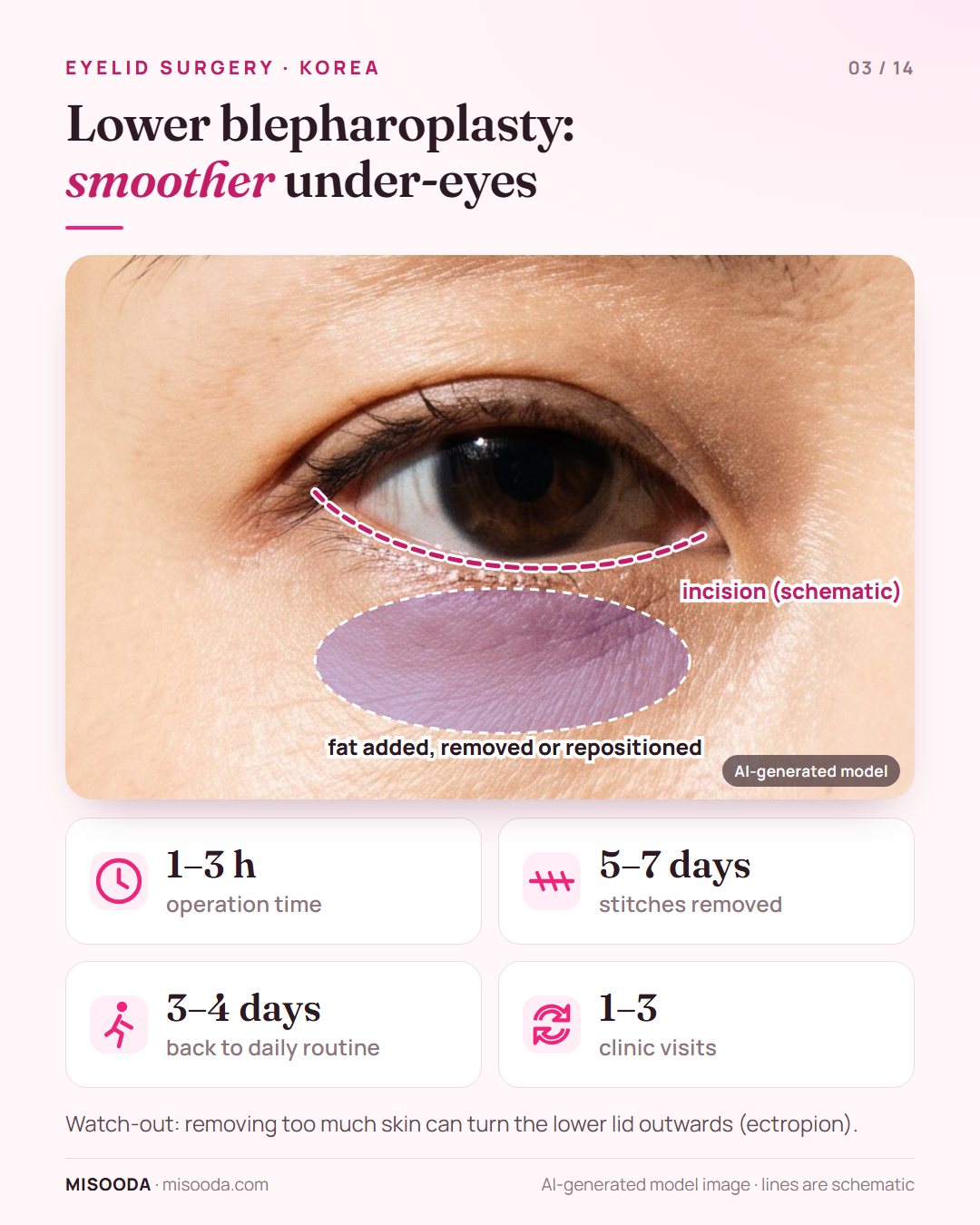 Lower blepharoplasty in Korea: droopy under-eye skin removed and under-eye fat added, removed or repositioned; 1–3 hours, stitches out in 5–7 days