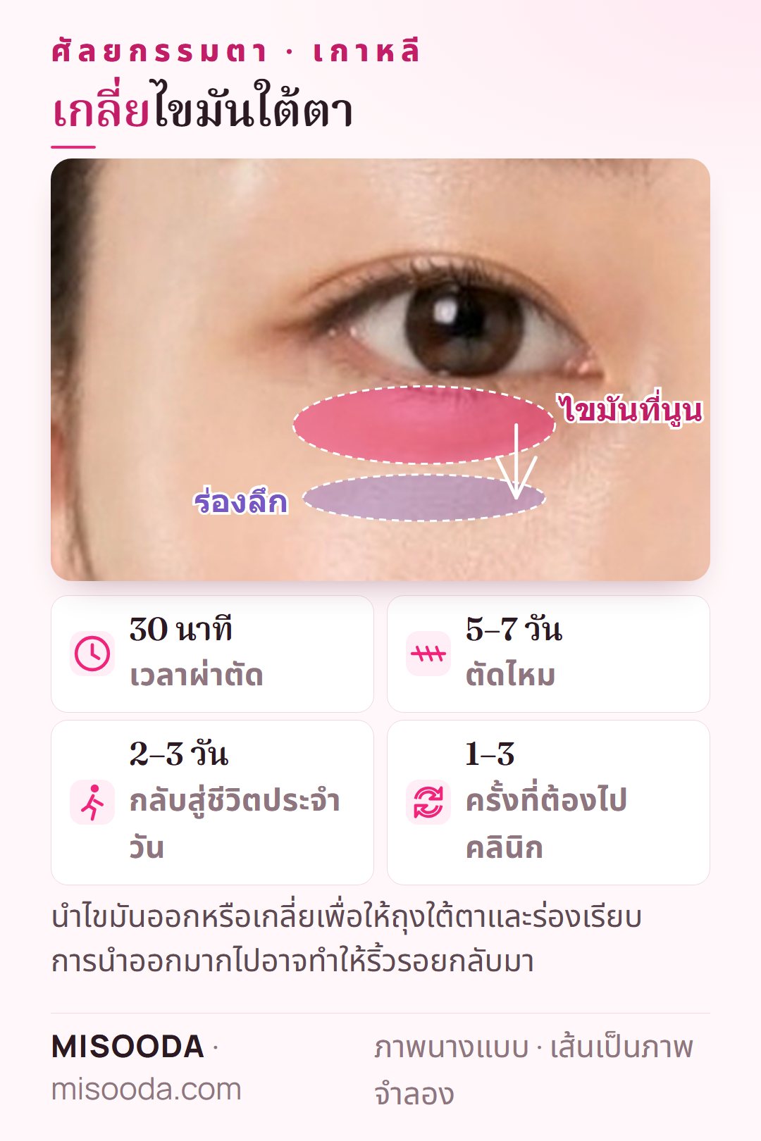 เกลี่ยไขมันใต้ตาในเกาหลี: นำไขมันถุงใต้ตาที่นูนออกหรือย้ายไปเติมร่องและรอยคล้ำ ใช้เวลา 30 นาที กลับสู่ชีวิตปกติใน 2–3 วัน