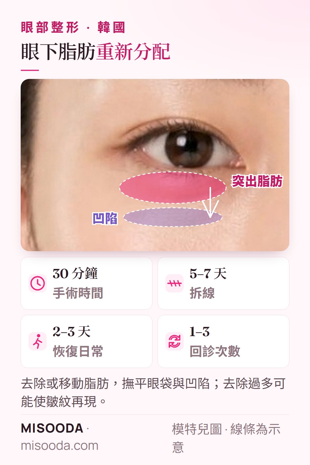 韓國 眼下脂肪重新分配:去除或移動突出的眼袋脂肪,撫平凹陷與黑眼圈;30 分鐘、2–3 天恢復日常