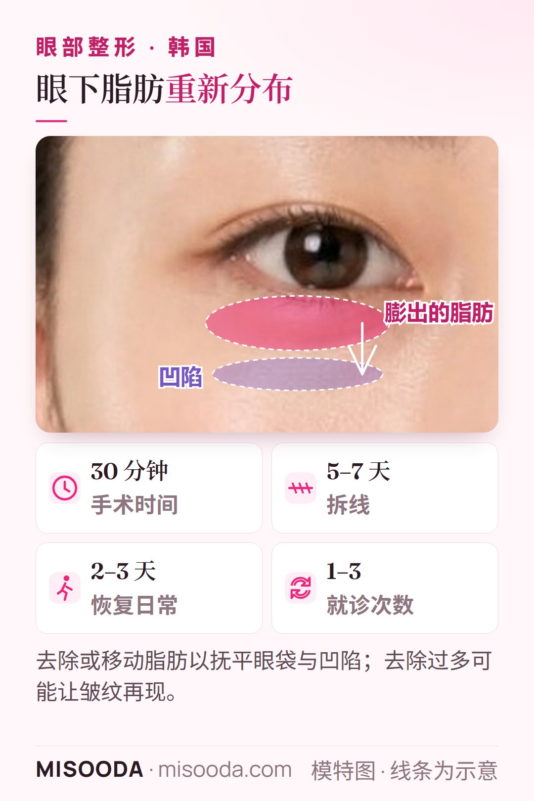 韩国 眼下脂肪重新分布:去除或移动膨出的眼袋脂肪以抚平凹陷与黑眼圈;手术 30 分钟,2–3 天恢复日常