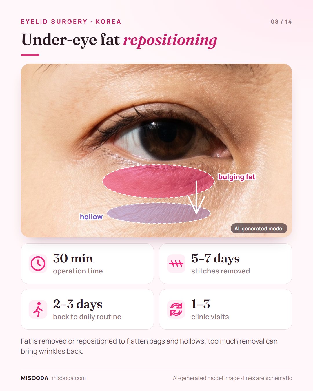 Under-eye fat repositioning in Korea: bulging eye-bag fat removed or moved to flatten hollows and dark circles; 30 minutes, back to routine in 2–3 days
