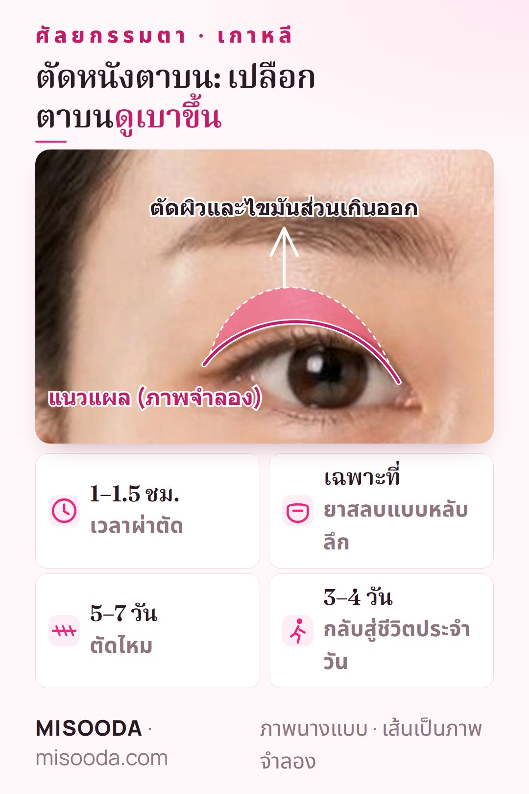 ตัดหนังตาบนในเกาหลี: ตัดผิวและไขมันส่วนเกินของเปลือกตาบนผ่านแผล ใช้เวลา 1–1.5 ชั่วโมง ตัดไหมใน 5–7 วัน กลับสู่ชีวิตปกติหลัง 3–4 วัน