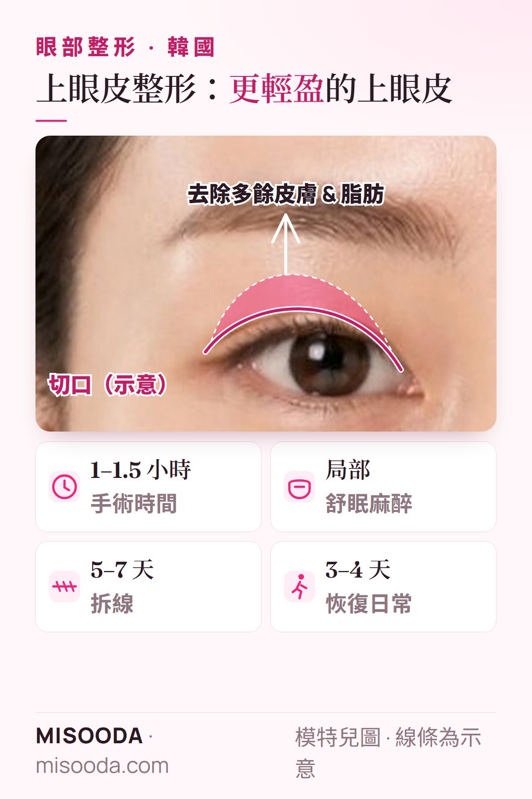 韓國 上眼皮整形:經切口去除上眼皮多餘皮膚與脂肪;1–1.5 小時、5–7 天拆線、3–4 天後恢復日常