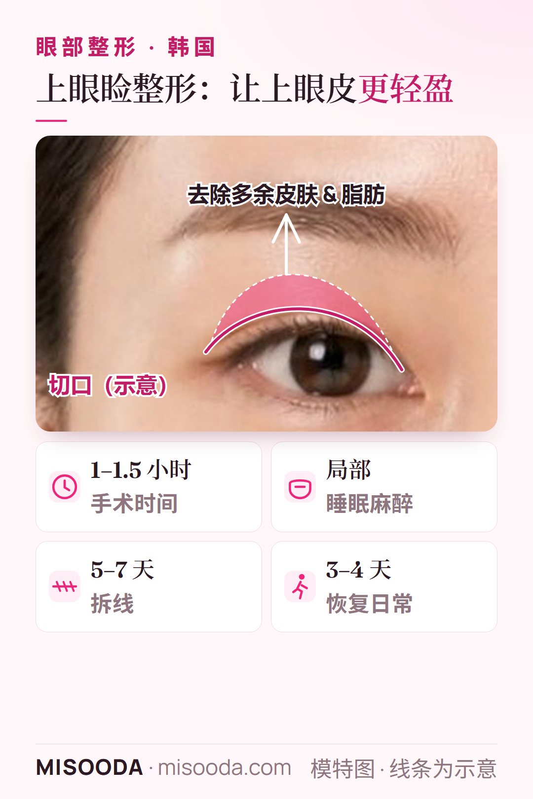 韩国 上眼睑整形:通过切口去除上眼皮多余皮肤与脂肪;手术 1–1.5 小时,5–7 天拆线,3–4 天后恢复日常