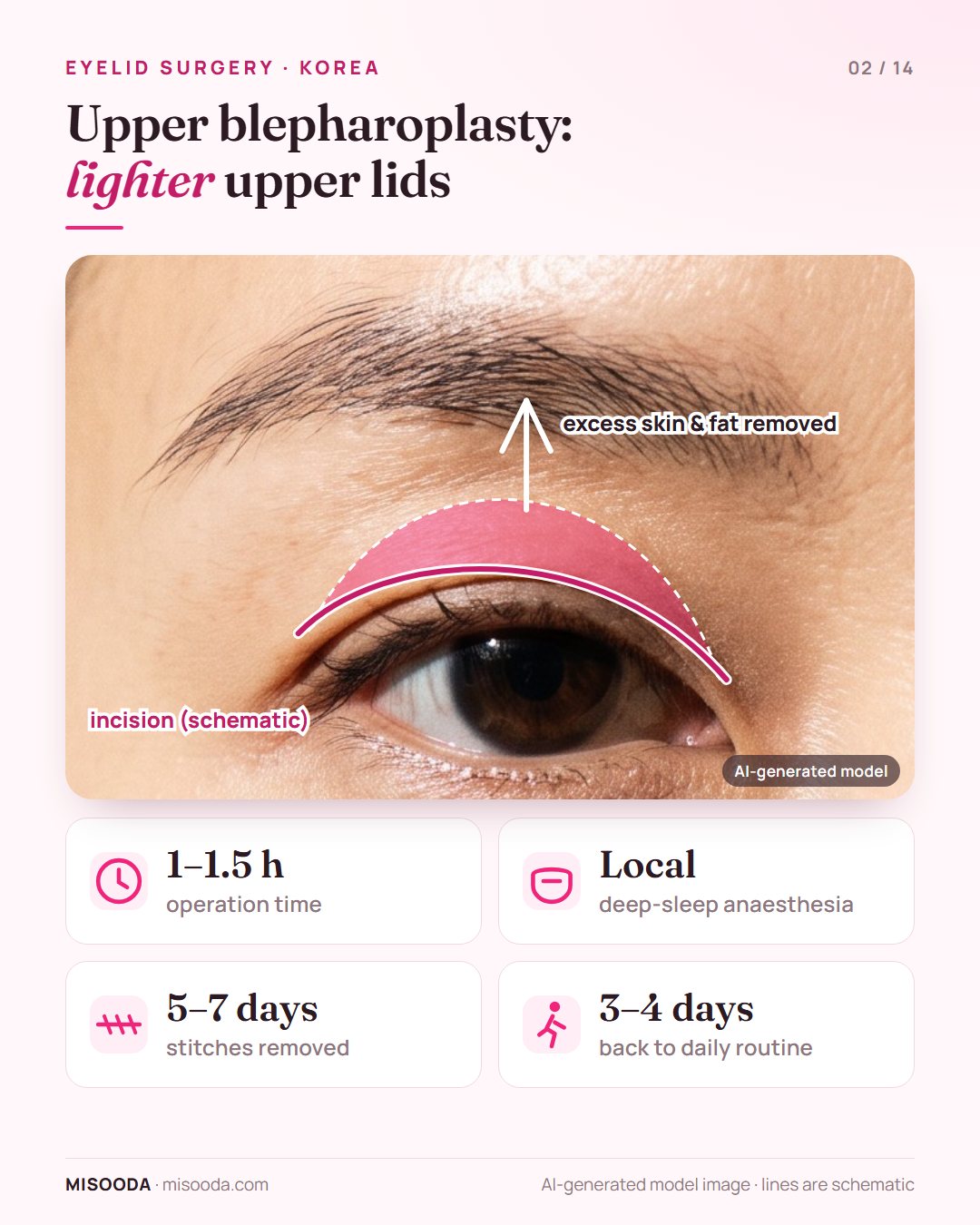 Upper blepharoplasty in Korea: excess upper eyelid skin and fat removed through an incision; 1–1.5 hours, stitches out in 5–7 days, routine after 3–4 days