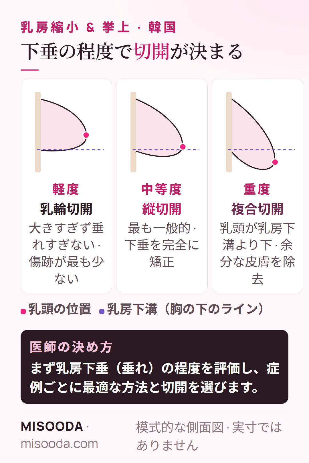 乳房下垂の程度と切開の対応:軽度は乳輪切開、中等度は縦切開、乳頭が下溝より下の重度は複合切開