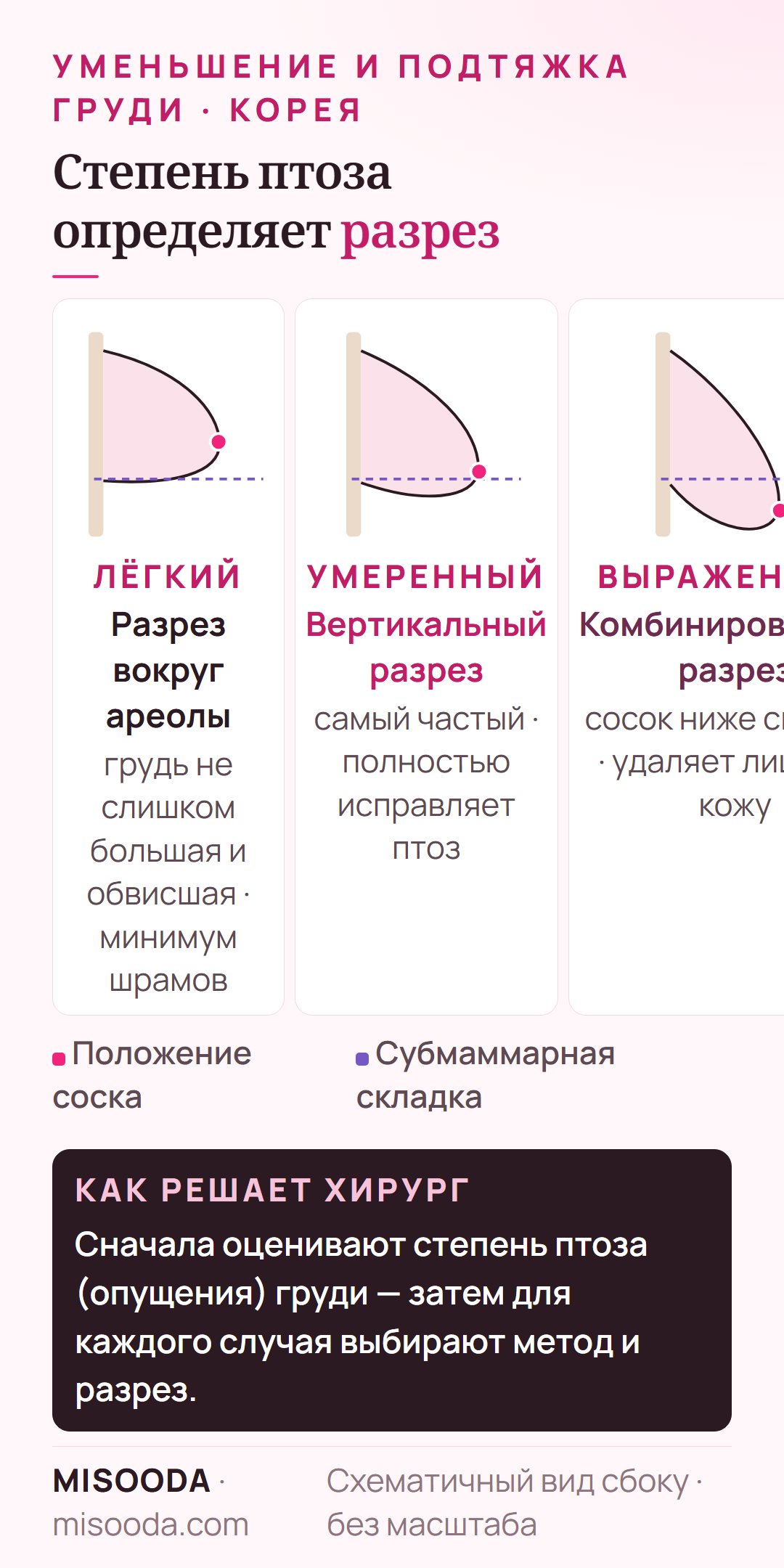 Степени птоза груди и разрез: лёгкий — вокруг ареолы, умеренный — вертикальный, выраженный с соском ниже складки — комбинированный разрез