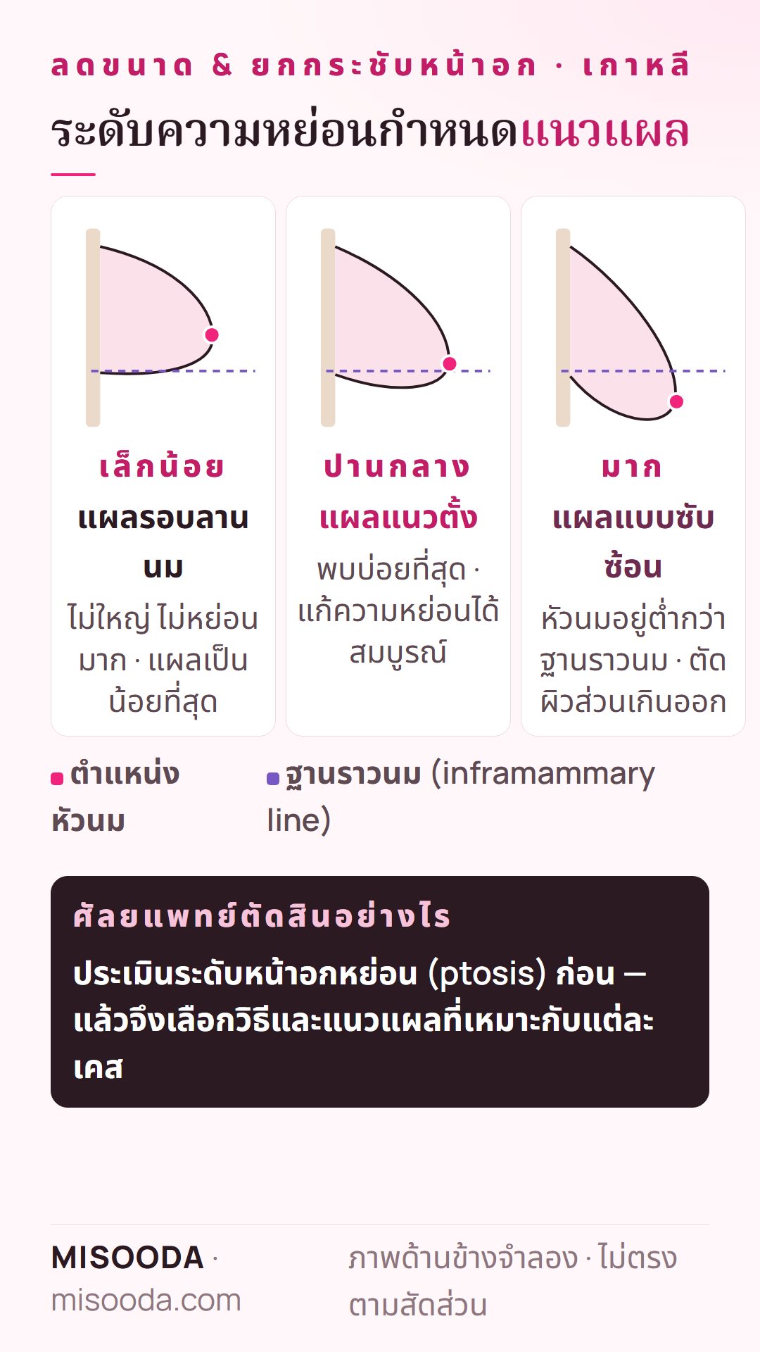 ระดับหน้าอกหย่อนกับแนวแผลที่เหมาะ: หย่อนเล็กน้อยแผลรอบลานนม ปานกลางแผลแนวตั้ง หย่อนมากหัวนมต่ำกว่าฐานราวนมใช้แผลแบบซับซ้อน