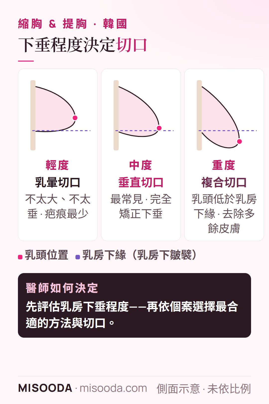 韓國 提胸 乳房下垂程度與對應切口:輕度乳暈切口、中度垂直切口、重度乳頭低於下緣採複合切口